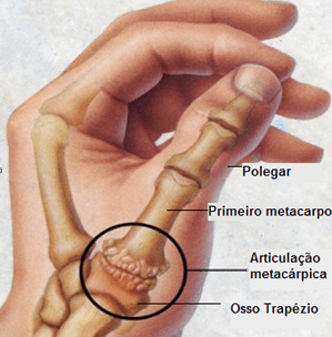 Rizartrose - processo degenerativo que acomete de 6% a 12% da população 1 Rizartrose