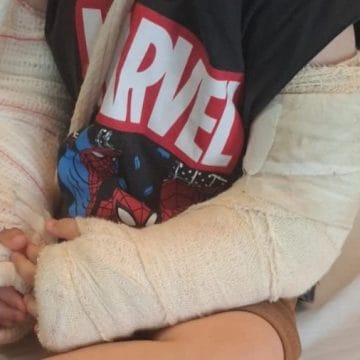 Imobilização provisória para alívio da dor 3