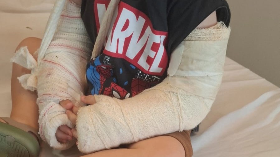 Imobilização provisória para alívio da dor 3